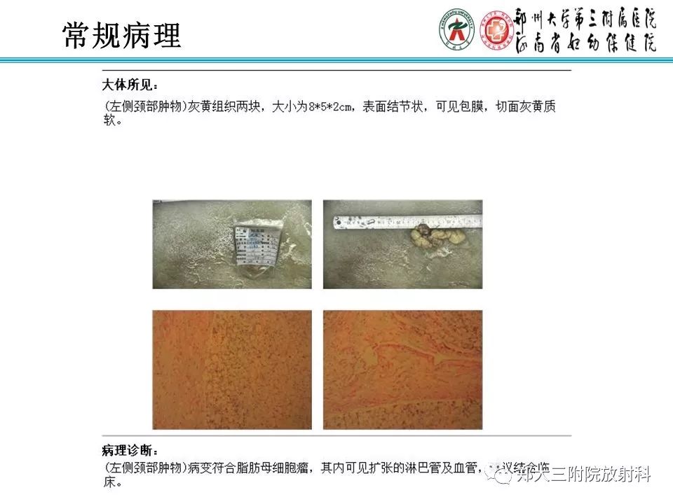 【病例】儿童颈部脂肪母细胞瘤1例影像诊断 【病例】儿童颈部脂肪母细胞瘤1例影像诊断