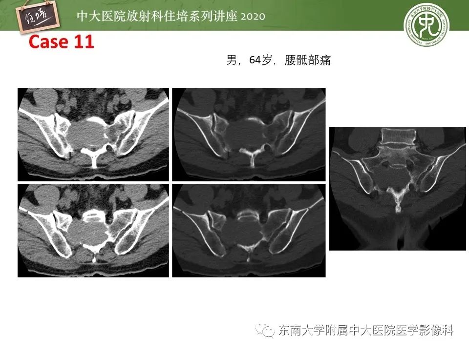 【PPT】脊柱骨源性病变影像分析思路及应用