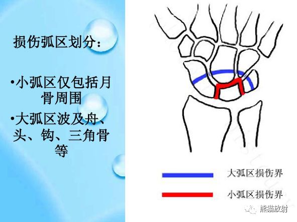 腕骨脱位的分类及X线表现