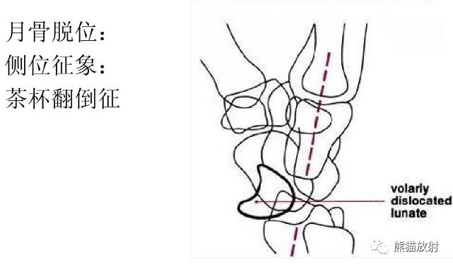 腕骨脱位的分类及X线表现