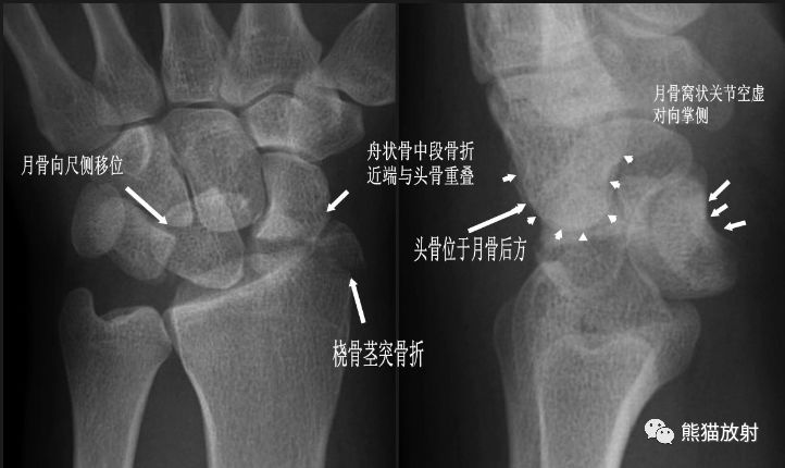 腕骨脱位的分类及X线表现