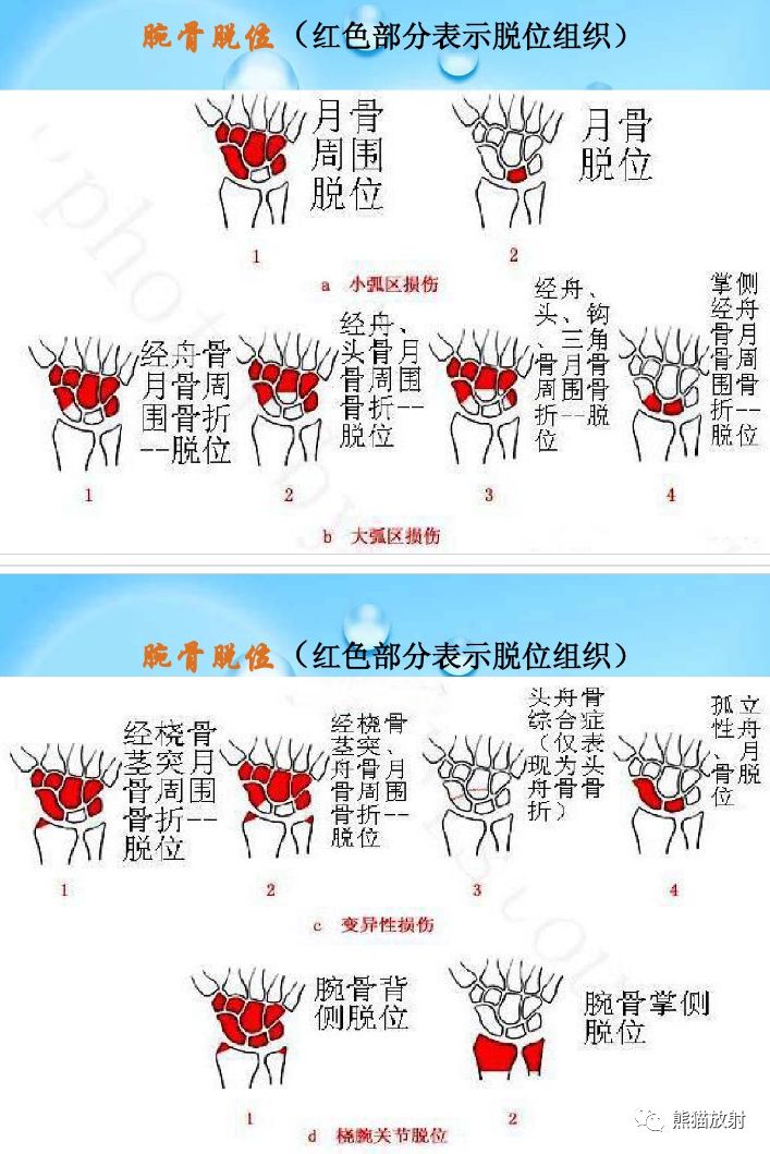 腕骨脱位的分类及X线表现