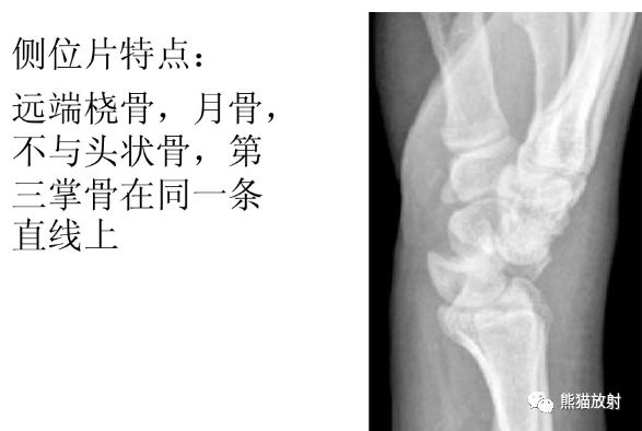 腕骨脱位的分类及X线表现