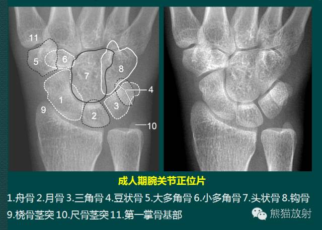 腕骨脱位的分类及X线表现