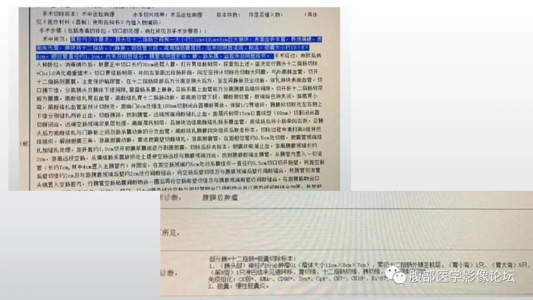 【病例】胰头部神经内分泌肿瘤1例CT影像