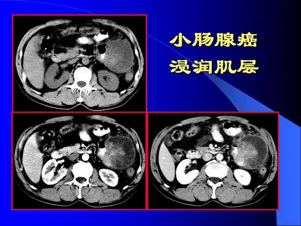 【PPT】小肠良恶性肿瘤CT诊断