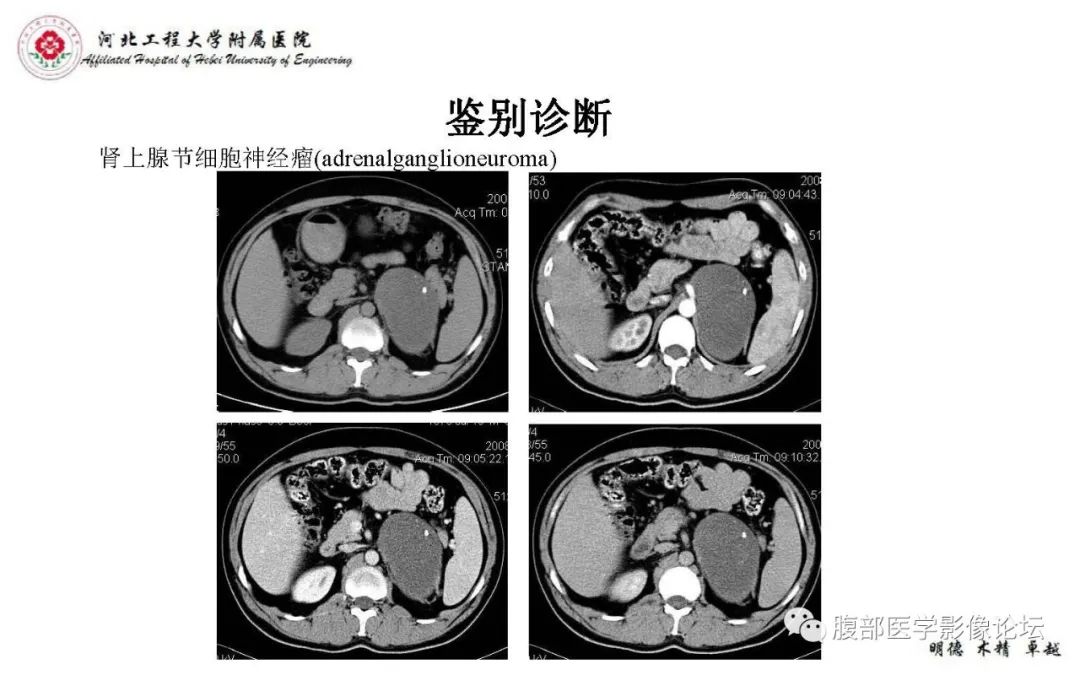 【PPT】肾上腺神经鞘瘤