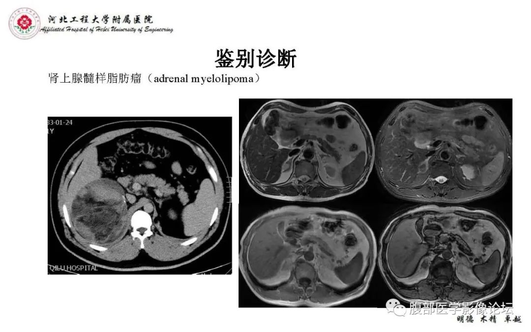 【PPT】肾上腺神经鞘瘤