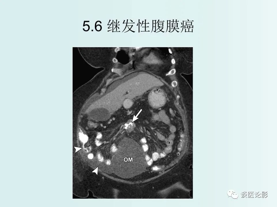 【PPT】腹膜及肠系膜的病变