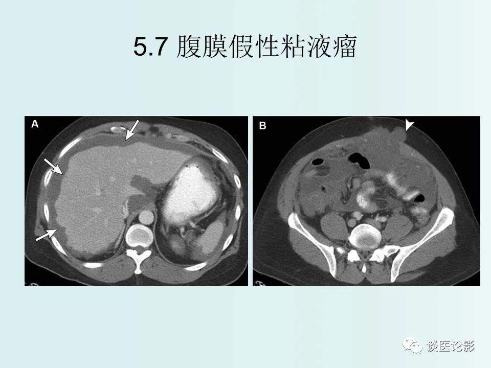 【PPT】腹膜及肠系膜的病变
