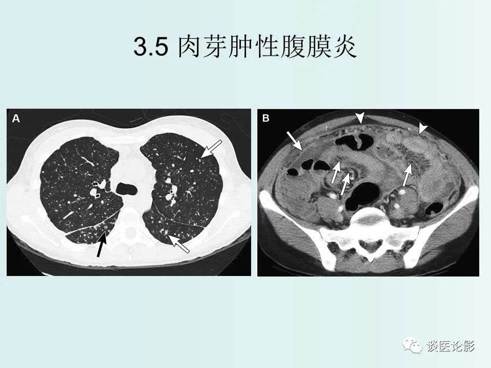 【PPT】腹膜及肠系膜的病变