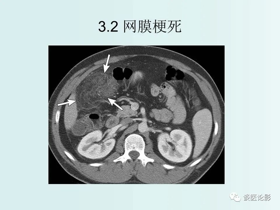 【PPT】腹膜及肠系膜的病变