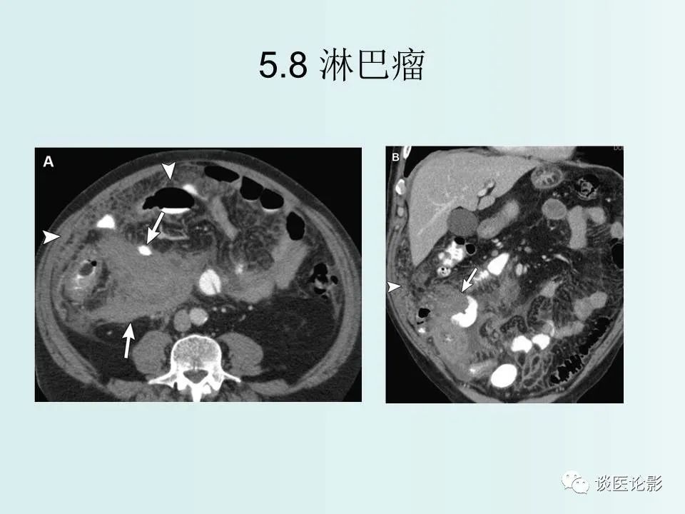 【PPT】腹膜及肠系膜的病变