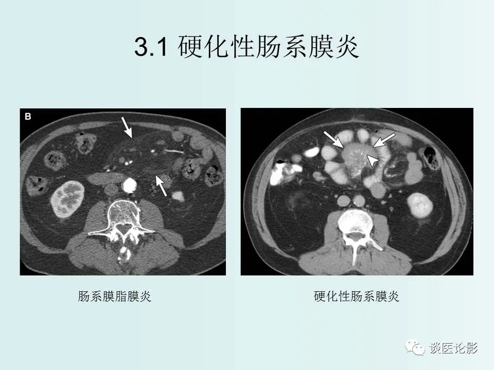 【PPT】腹膜及肠系膜的病变