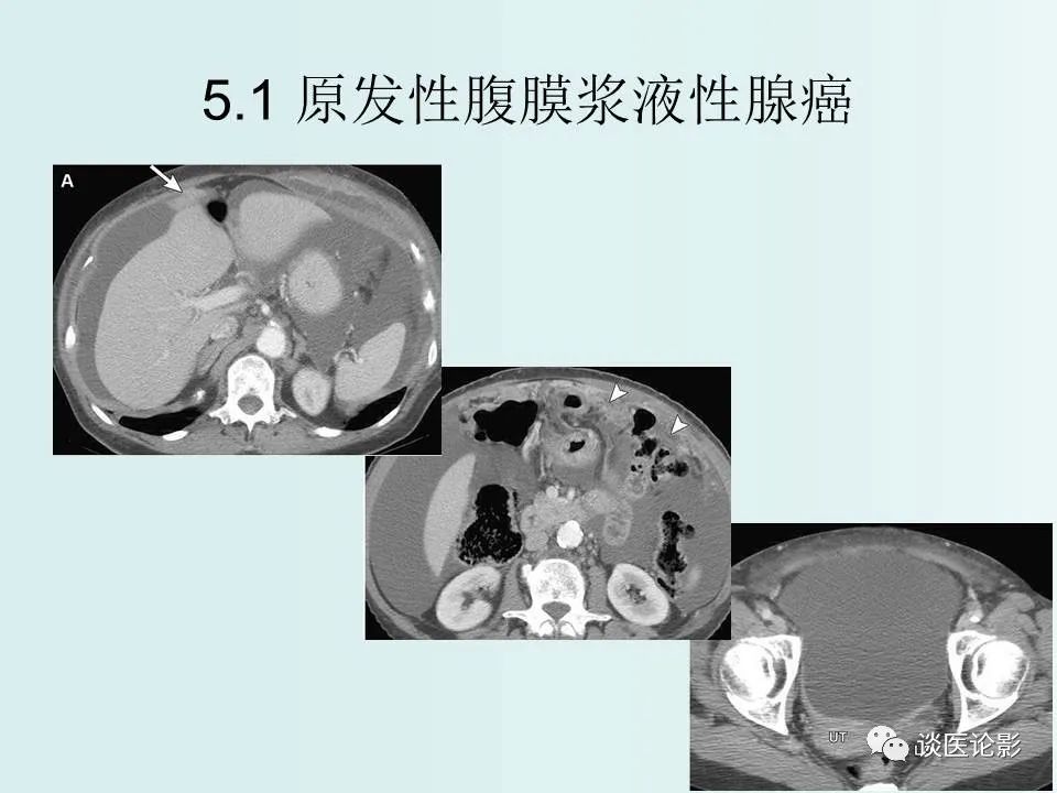 【PPT】腹膜及肠系膜的病变