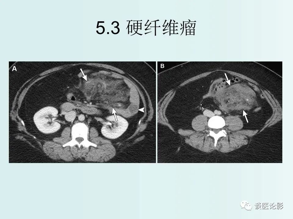 【PPT】腹膜及肠系膜的病变