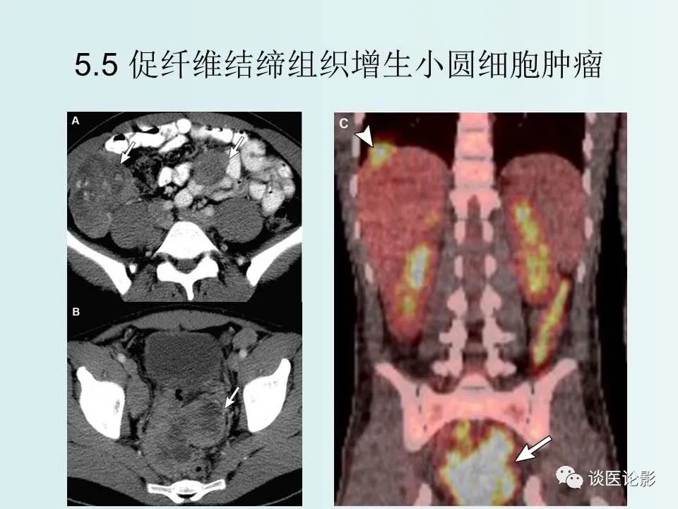 【PPT】腹膜及肠系膜的病变