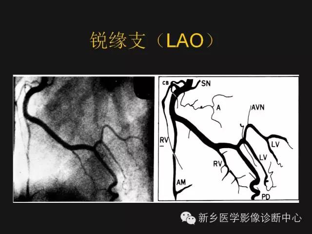 【PPT】冠状动脉造影正常解剖