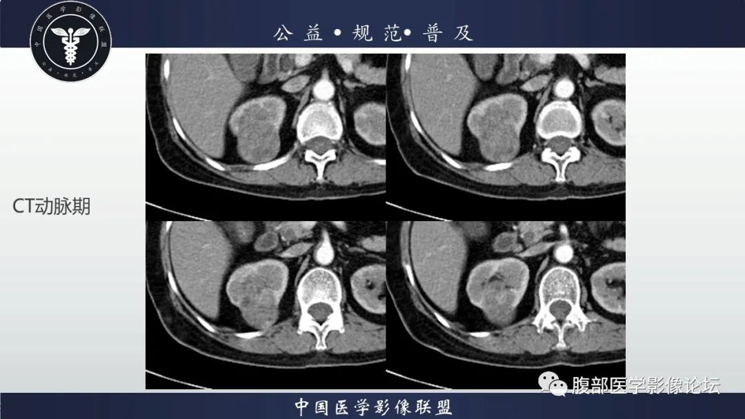 【病例】肾脏乳头状肾细胞癌1例CT及MR影像讨论
