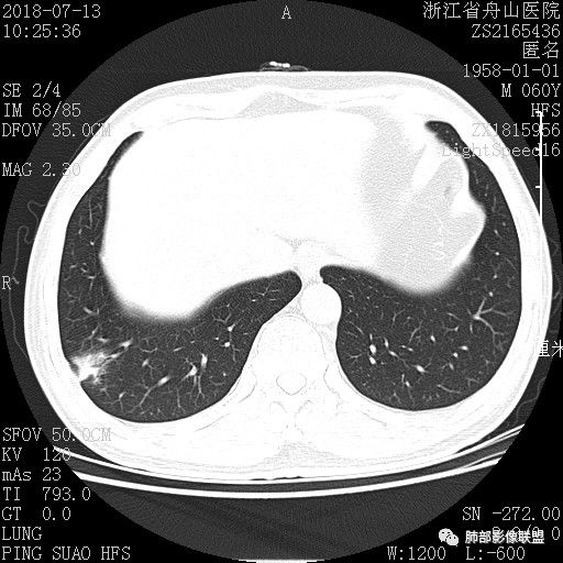 【病例】肺隐球菌病1例CT影像