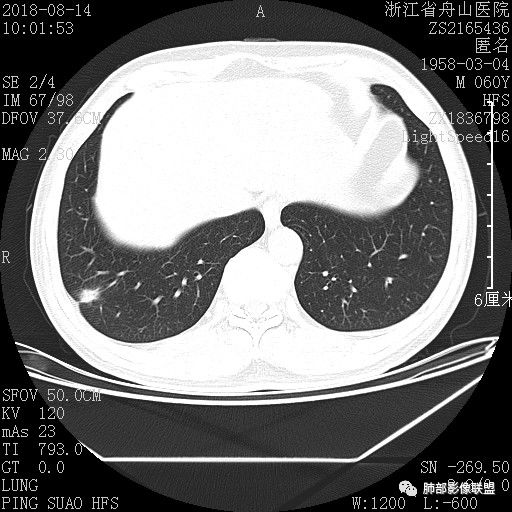 【病例】肺隐球菌病1例CT影像