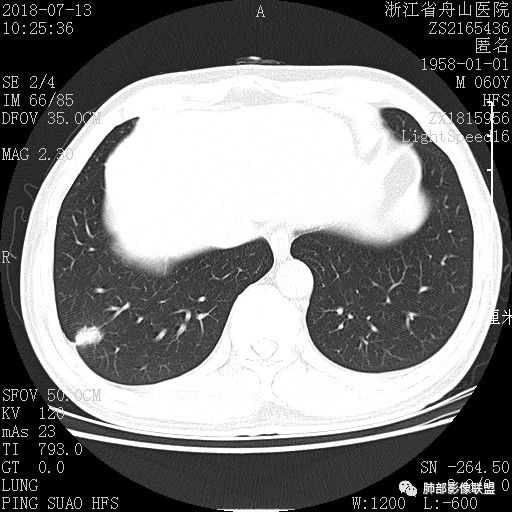 【病例】肺隐球菌病1例CT影像