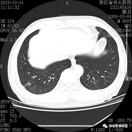 【病例】肺隐球菌病1例CT影像