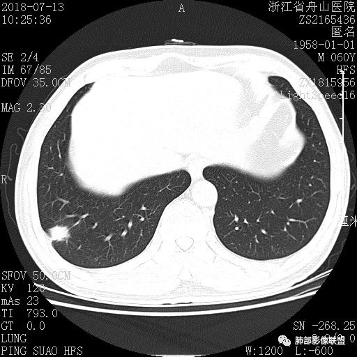 【病例】肺隐球菌病1例CT影像