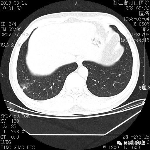 【病例】肺隐球菌病1例CT影像