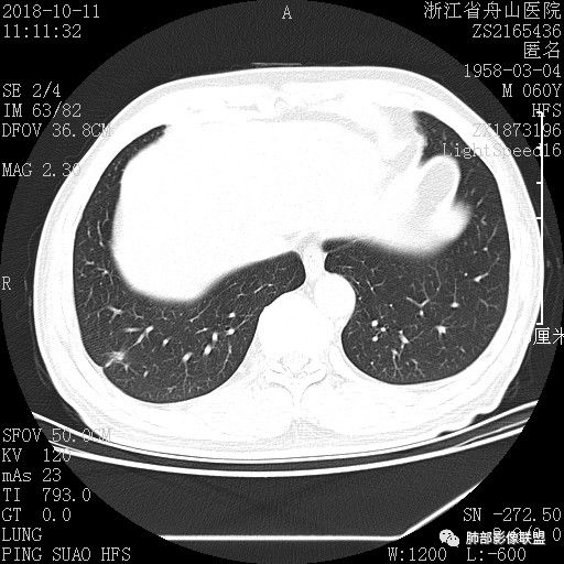 【病例】肺隐球菌病1例CT影像
