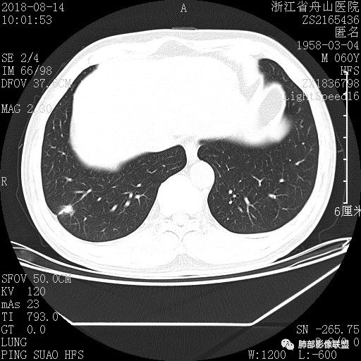 【病例】肺隐球菌病1例CT影像
