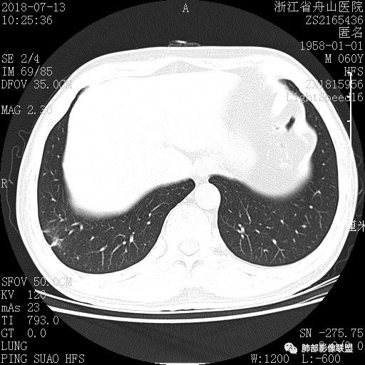 【病例】肺隐球菌病1例CT影像