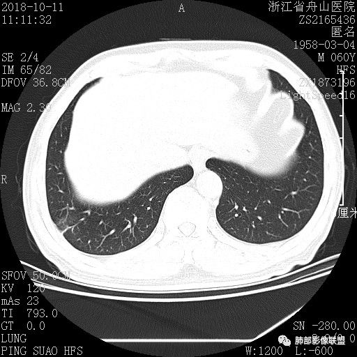 【病例】肺隐球菌病1例CT影像