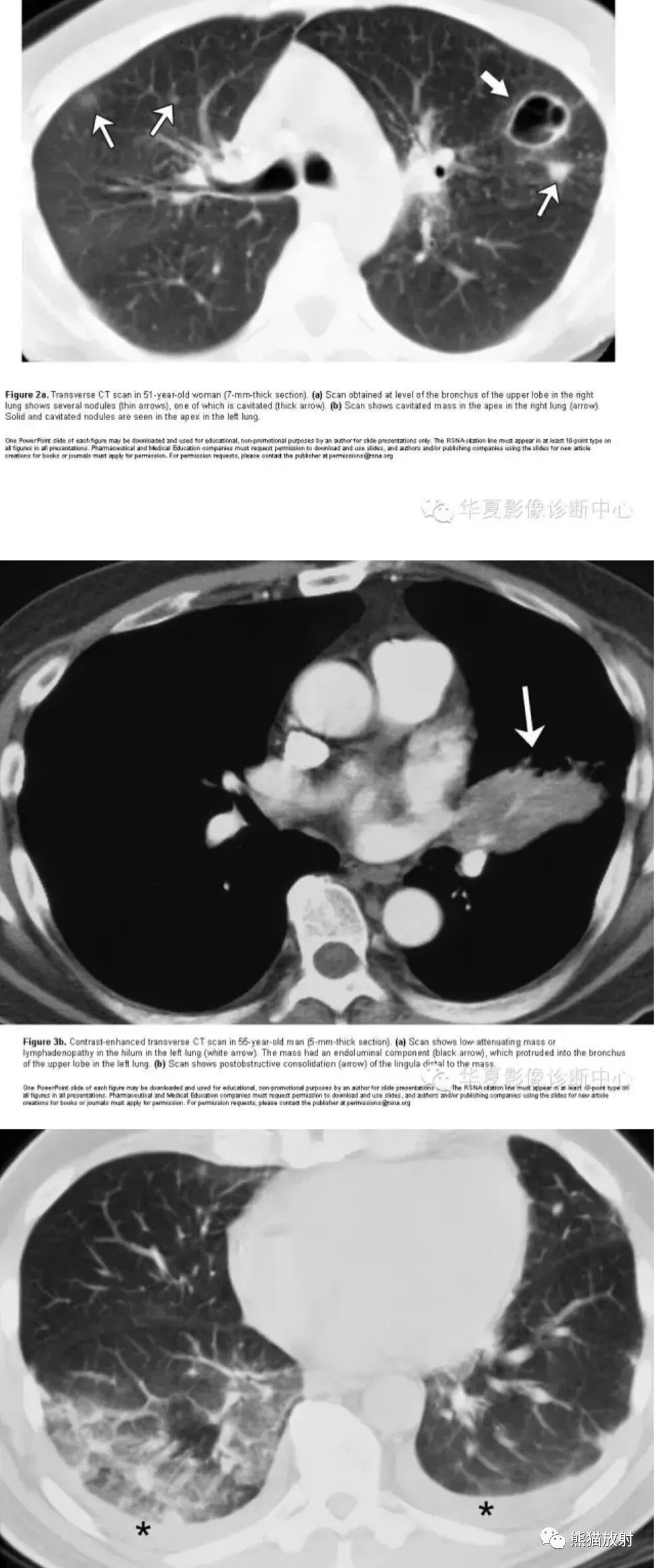 【病例】表现为多发结节的肺隐球菌病1例CT影像
