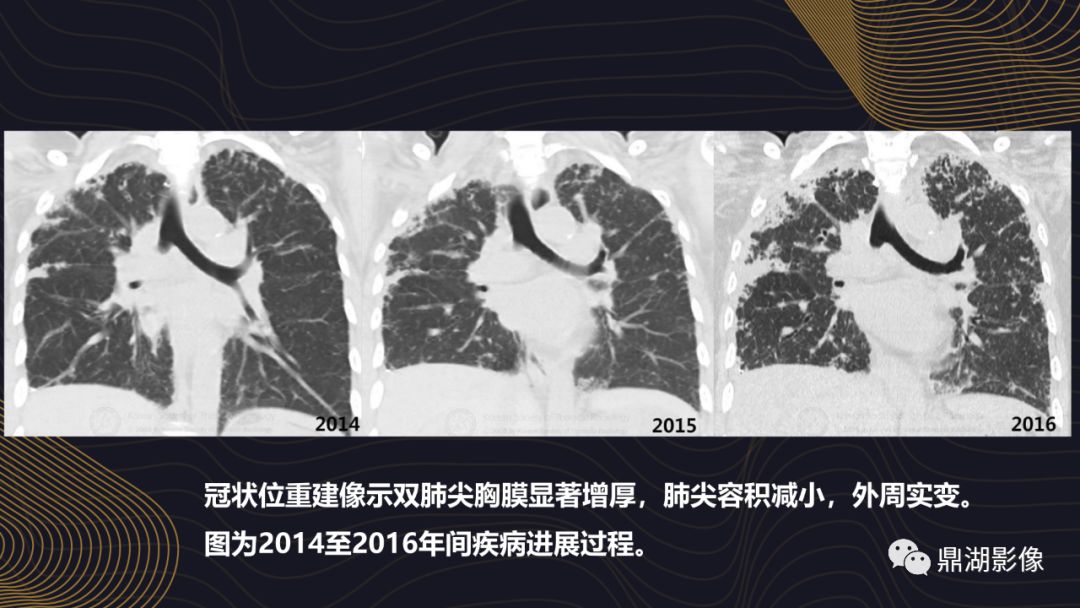 【病例】胸膜肺实质弹力纤维增生症1例CT影像