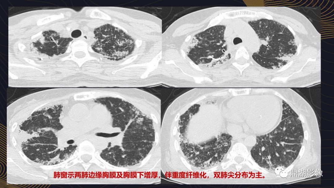【病例】胸膜肺实质弹力纤维增生症1例CT影像