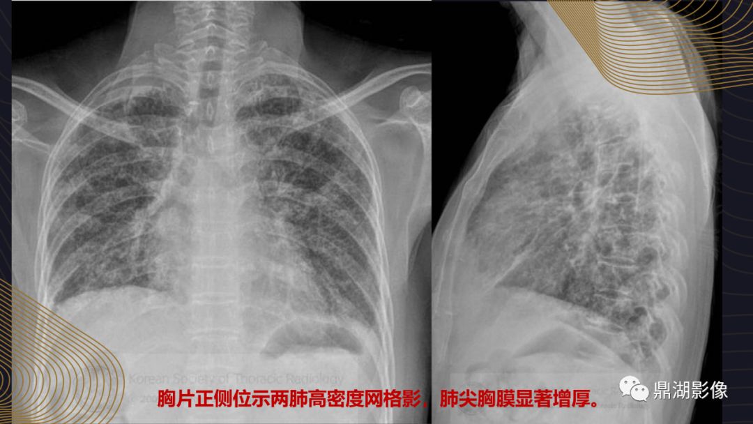 【病例】胸膜肺实质弹力纤维增生症1例CT影像