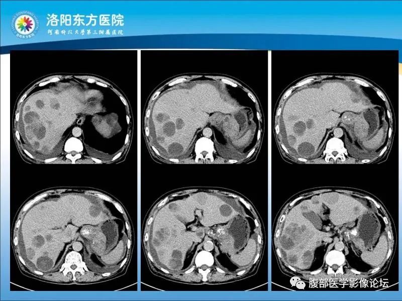 【病例】胃肝样腺癌肝内多发转移1例CT影像 【病例】胃肝样腺癌肝内多发转移1例CT影像