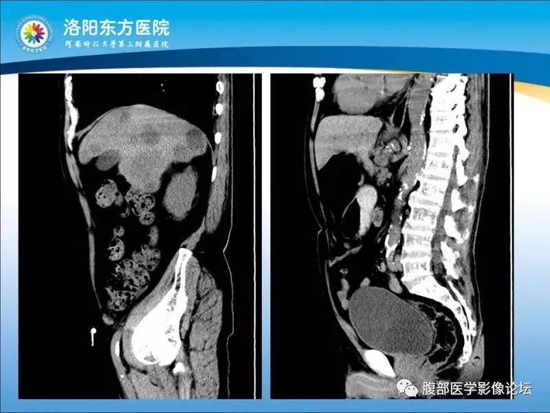 【病例】胃肝样腺癌肝内多发转移1例CT影像 【病例】胃肝样腺癌肝内多发转移1例CT影像