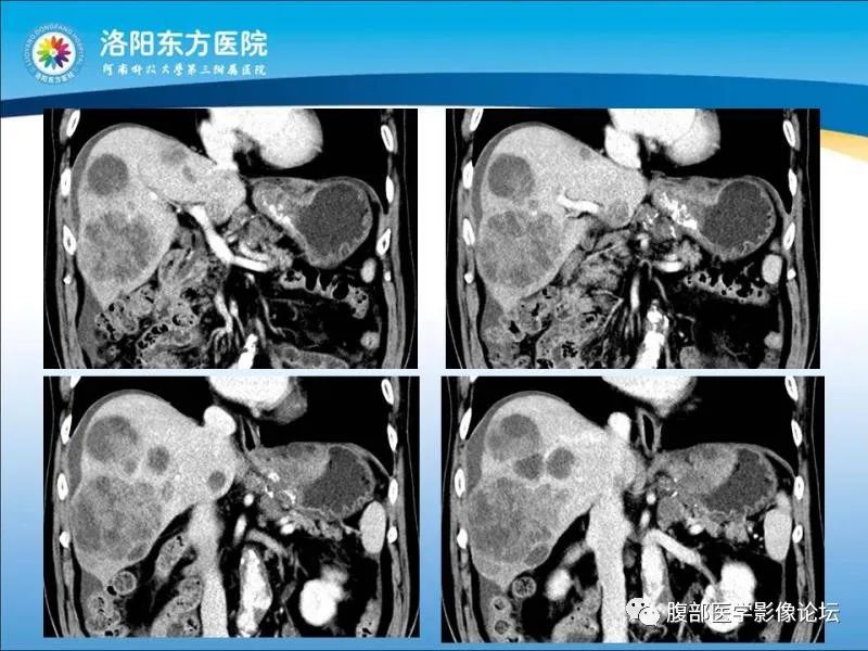 【病例】胃肝样腺癌肝内多发转移1例CT影像 【病例】胃肝样腺癌肝内多发转移1例CT影像