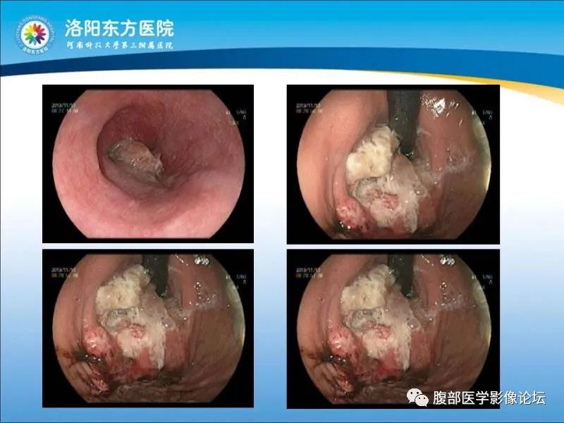 【病例】胃肝样腺癌肝内多发转移1例CT影像 【病例】胃肝样腺癌肝内多发转移1例CT影像