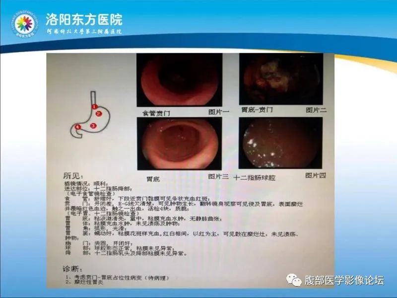 【病例】胃肝样腺癌肝内多发转移1例CT影像 【病例】胃肝样腺癌肝内多发转移1例CT影像