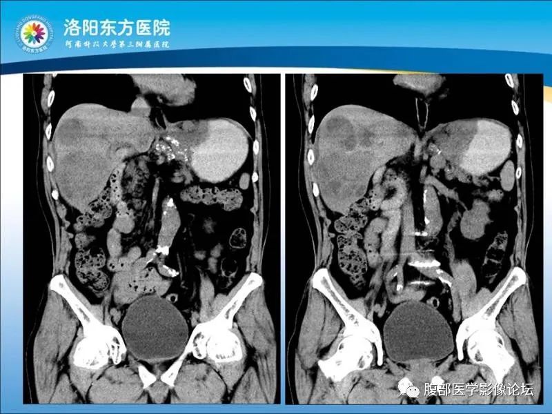 【病例】胃肝样腺癌肝内多发转移1例CT影像 【病例】胃肝样腺癌肝内多发转移1例CT影像