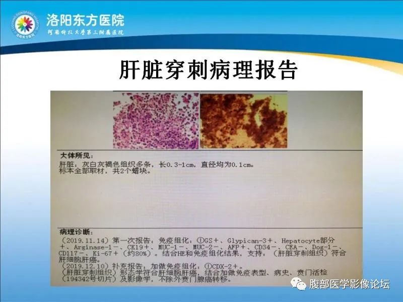【病例】胃肝样腺癌肝内多发转移1例CT影像 【病例】胃肝样腺癌肝内多发转移1例CT影像