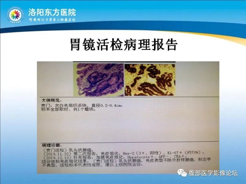 【病例】胃肝样腺癌肝内多发转移1例CT影像 【病例】胃肝样腺癌肝内多发转移1例CT影像