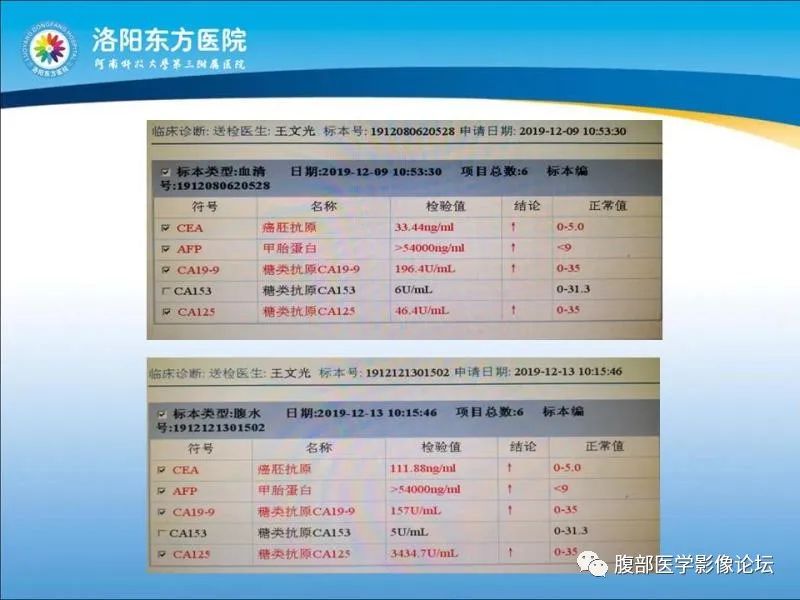 【病例】胃肝样腺癌肝内多发转移1例CT影像 【病例】胃肝样腺癌肝内多发转移1例CT影像