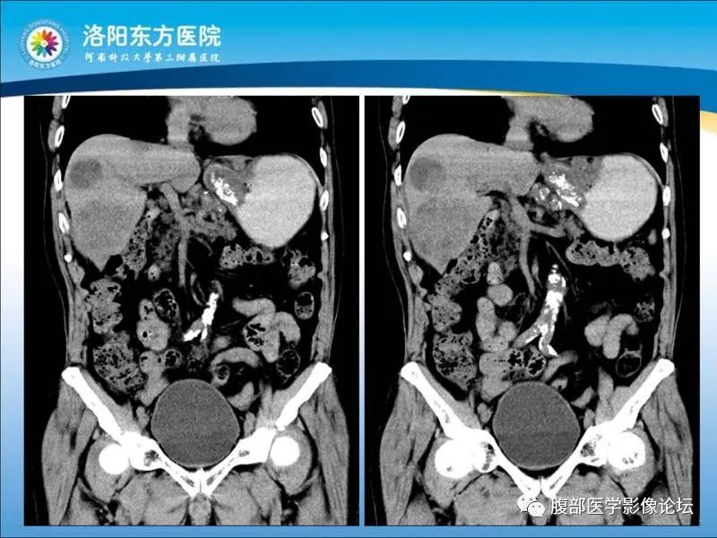 【病例】胃肝样腺癌肝内多发转移1例CT影像 【病例】胃肝样腺癌肝内多发转移1例CT影像