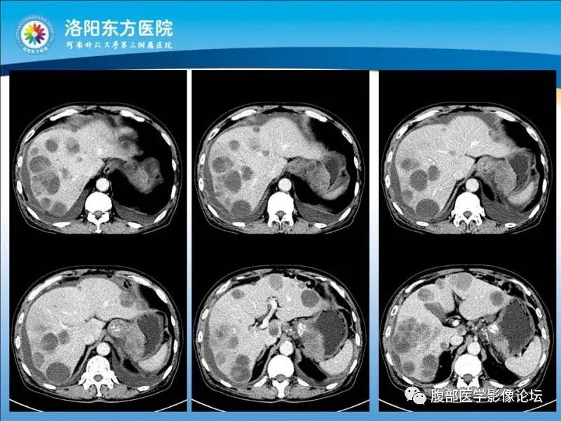 【病例】胃肝样腺癌肝内多发转移1例CT影像 【病例】胃肝样腺癌肝内多发转移1例CT影像