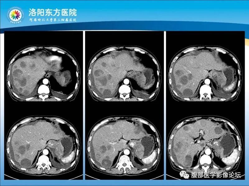 【病例】胃肝样腺癌肝内多发转移1例CT影像 【病例】胃肝样腺癌肝内多发转移1例CT影像