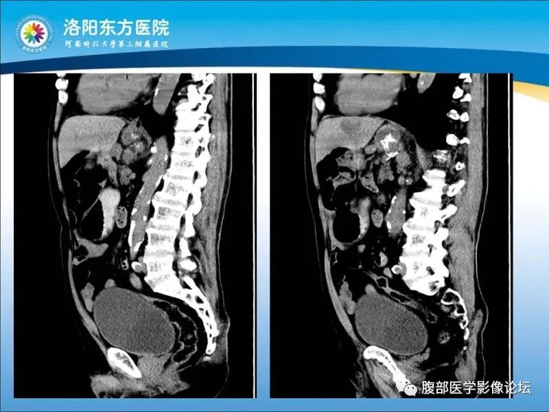 【病例】胃肝样腺癌肝内多发转移1例CT影像 【病例】胃肝样腺癌肝内多发转移1例CT影像